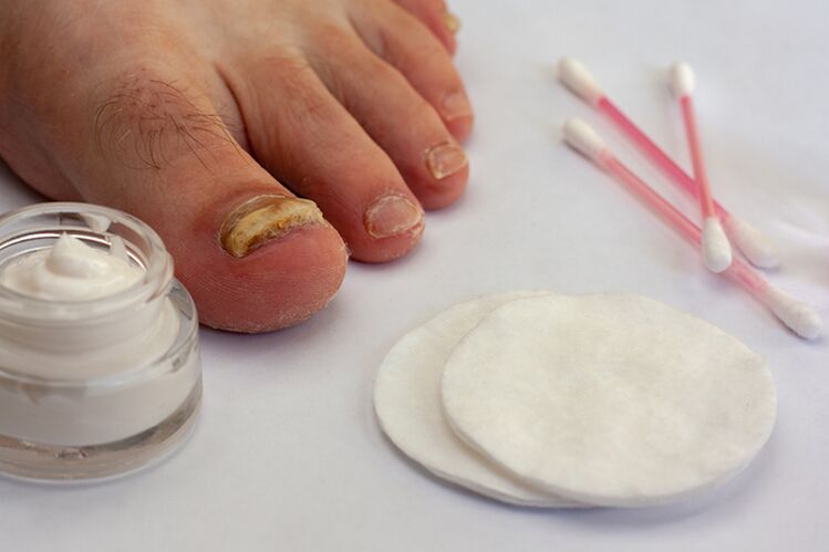 Θεραπεία μυκήτων toe με κρέμα μανιταριών