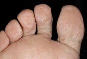 Μυκητιακά συμπτώματα στο δέρμα των ποδιών