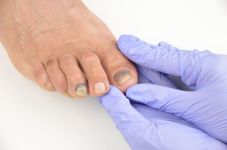 Ιατρική εξέταση των νυχιών των ποδιών που έχουν προσβληθεί από μύκητα