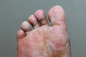 Σοβαρό στάδιο της μυκητιάσεις του δέρματος των ποδιών
